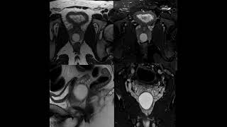 Mri prostate for 29 y patient [upl. by Esorrebma]