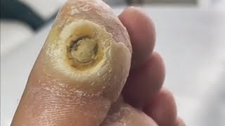 Pedicure video34，vertical plantaris，plantar wart [upl. by Pals930]