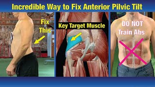 INCREDIBLE Way to Fix Anterior Pelvic Tilt  NEVER BEFORE Seen Exercise [upl. by Felix]