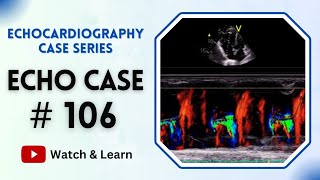 ECHO Case 106  Echocardiography for Beginners echocardiogram [upl. by Aerbua177]