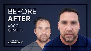 Remarkable Hair Transplant Result with Dr Acar [upl. by Daphie]