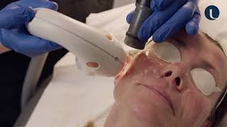 IPL treatment for rosacea  Intense Pulsed Light demo at Quinn Clinics Bristol [upl. by Tucky]