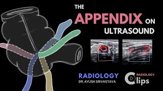 The Appendix on ultrasound and Acute appendicitis  Radiology [upl. by Stralka892]