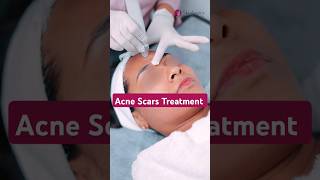 How to treat Acne Scars on face  Acne scars treatment  Acne scar treatment in noida [upl. by Eizus901]