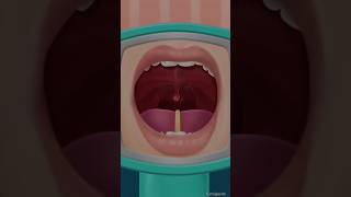 2side thorat pus injection remove mouth care asmr relaxing satisfying shorts cleaning asmr [upl. by Ayela]