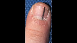 Dermatology Wk8WedSpr20 Anatomy of the Nail Then Learn About Melanonychia [upl. by Aura]