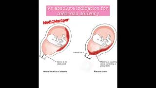 Placenta previa Cesarean sectiondoctor anatomy obstetrician nursing medicalstudent [upl. by Voleta]