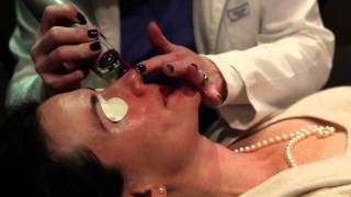 Laser treatment for Rosacea Birmingham Alabama  Cosmetic Dermatology [upl. by Ethelin]