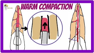 ENDODONTICS  OBTURATION TECHNIQUES  Warm Vertical Compaction technique [upl. by Oibesue]