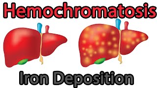 Hemochromatosis Easy explained symptoms causes treatment prognosis [upl. by Timmi]