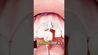 COME FUNZIONA IL TRAPIANTO DI DENTI credits ​⁠zackdfilms [upl. by Cartie951]