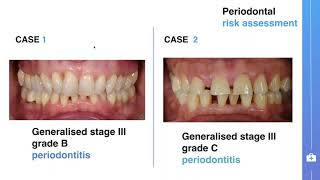 Symposium on stage IIII periodontitis treatment guideline  Yaman Altaep from Liège [upl. by Oribel]