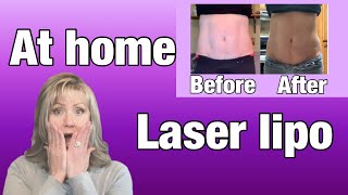 AT HOME LASER LIPO  Radio Frequency Therapy at Home  fat cavitation before and after [upl. by Felisha236]