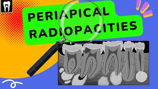 Periapical lesions  Periapical radiopacities  Oral radiology Apical radiopacities [upl. by Ehman]