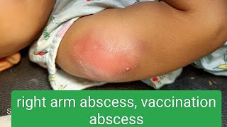 vaccination abscess [upl. by Drareg538]