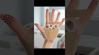 ASMR Animation Treatment Maggot Removal from Infected Hands  Deep Clean Animation [upl. by Sandra]