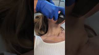 Morpheus8 Face Neck amp Chest Treatment at South Coast MedSpa [upl. by Ylrebmek167]