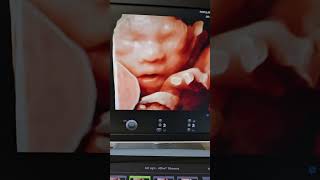 36th Week Fetal Face 3D Ultrasound [upl. by Gnni]