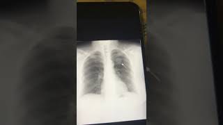 Chest Xray  Mass lesion consolidation secondary deposits [upl. by Droffig]