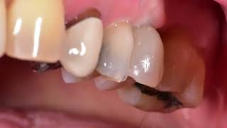 46 Dental Cyst and Implant Case [upl. by Salamanca]