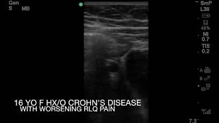 Worsening RLQ Pain in 16 yo Girl with Crohns Disease [upl. by Bekha]