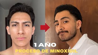 1 AÑO USANDO MINOXIDIL PARA CRECER BARBA SIENDO 100 LAMPIÑO [upl. by Yrrum482]