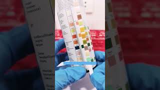 Urinalysis results showing Red blood cells in urine Hematuria laboratory [upl. by Haron921]