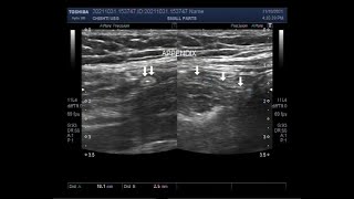 Normal Appendix and Rt Salpingitis with Lt Ovarian Chocolate Cyst [upl. by Laraine]