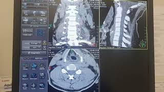 Canon CT Axial Cervical Spine recons [upl. by Anaitsirk]