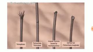 Trichoscopy basic Part 3 Amr Ammar MD [upl. by Lipps]