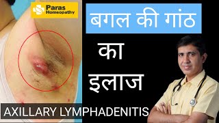 बगल की गाँठ  Axillary Lymphadenitis  Armpit Lymph Nodes Swollen  Swollen Lymph Nodes Treatment [upl. by Eciruam]