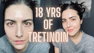 Not Seeing Results with RetinA TRETINOIN Watch This Before You Quit amp Avoid My Biggest Mistake [upl. by Louie]