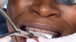 removing braces orthodontic [upl. by Suoivatco26]