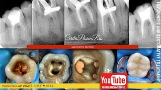 one visit endodontic retreatment mandibular molar rebilda dc spesialis konservasi gigi [upl. by Alroy407]