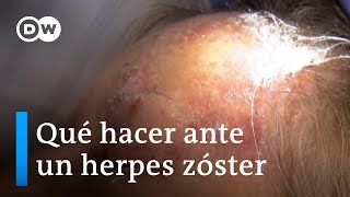 Primero varicela luego herpes zóster [upl. by Ruffin436]