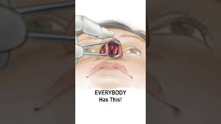 Nasal Obstruction Due to Turbinate Hypertrophy shorts fauquierent [upl. by Itsirc585]