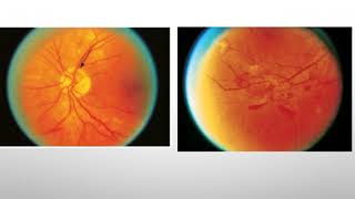 Retinopatía Diabética no prolifera y Proliferativa y coriorretinopatía serosa Central [upl. by Ludeman]