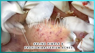 Big Cystic Acne Blackheads Extraction Blackheads amp Milia Whiteheads Removal Pimple Popping [upl. by Sapienza]