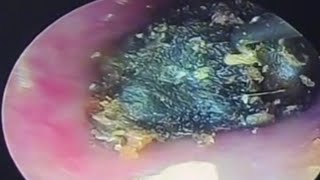 Colossal Earwax Blockage  earwax Cleaning earwaxremoval satisfying lullaby relieveanxiety [upl. by Zacharia289]