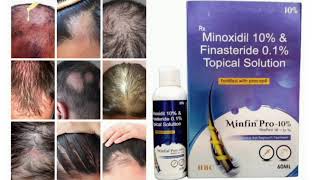 Minfin Pro 10 Topical Solution Minoxidil 10 amp Finasteride 01 Topical Solution [upl. by Brittany]