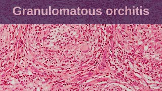 Idiopathic Granulomatous Orchitis  Pathology mini tutorial [upl. by Vevina]