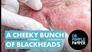 A CHEEKY BUNCH OF BLACKHEADS [upl. by Aikenahs]