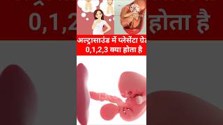 Pregnancy Ultrasound me Placenta Grade 0123 kya hota hai shorts pregnancy placenta pregnant [upl. by Uhthna]