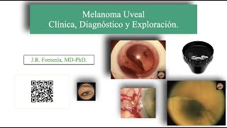 Melanoma Uveal Clínica Diagnóstico y Exploración [upl. by Nileak]