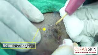 Nevus Sebaceous Of Jadasohn Removal By RC Excision Treatment  Clear Skin Hair and Laser Centre [upl. by Tay]