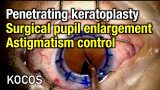 Penetrating keratoplasty surgical pupil enlargement astigmatism control [upl. by Avehstab]