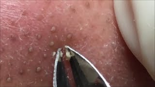 角栓 除去 blackheads removal 065 [upl. by Hatokad]