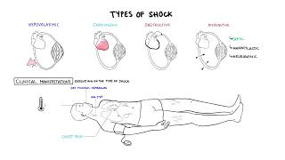 Approach to Shock  types hypovolemic cardiogenic distributive anaphylaxis pathology treatment [upl. by Euqinahs]