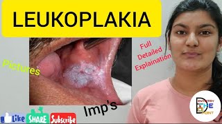 LEUKOPLAKIA  PREMALIGNANT LESION [upl. by Kozloski154]