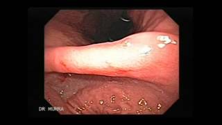 Video clip of an Upper Endoscopy [upl. by Sopher]